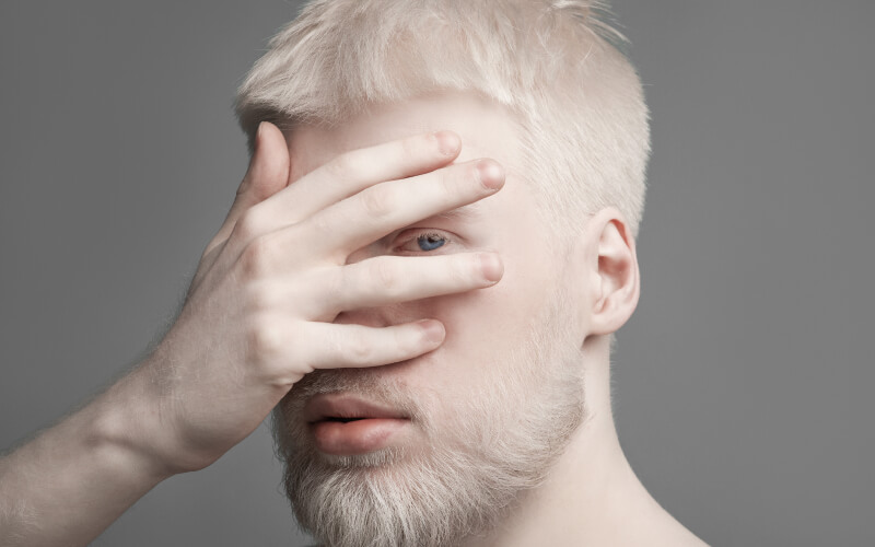 Más allá del color de la piel: Albinismo